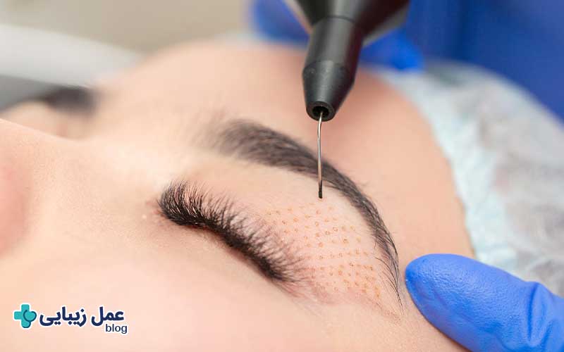 عمل بلفاروپلاستی 5 بلفاروپلاستی بدون جراحی