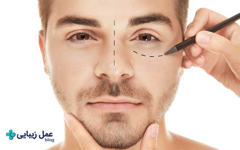 عمل بلفاروپلاستی 3 بلفاروپلاستی پلک پایین