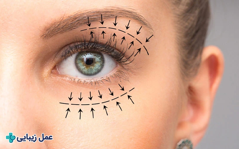 عمل بلفاروپلاستی 2 بلفاروپلاستی