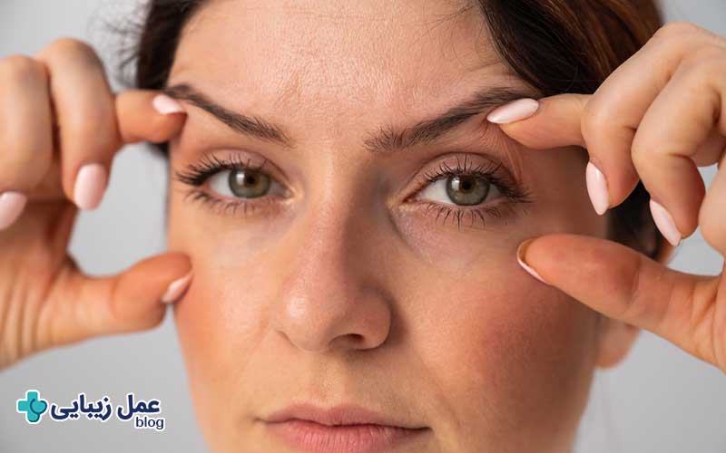 عمل بلفاروپلاستی 4 بهترین سن برای عمل بلفاروپلاستی