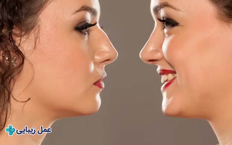 عمل بینی 1 عمل بینی