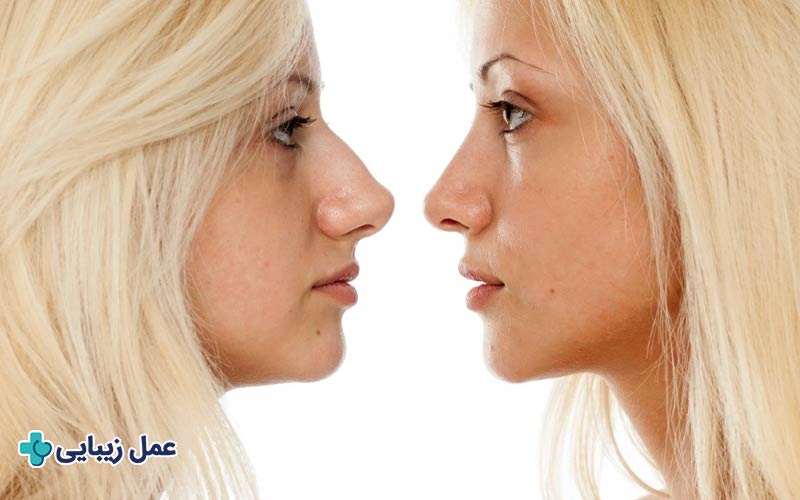 عمل بینی 4 بینی برای چه کسانی مناسب است؟