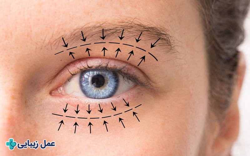 عمل بلفاروپلاستی 1 بلفاروپلاستی