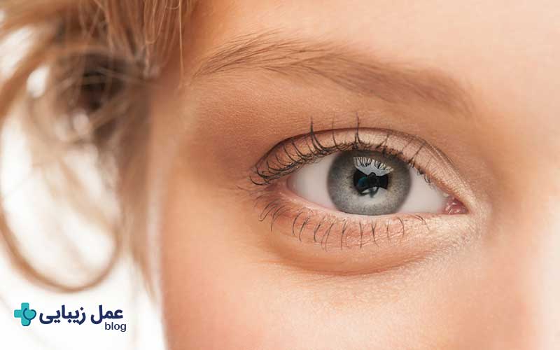 جراحی بلفاروپلاستی یا لیفت ابرو؟ کدام برای شما بهتر است؟ 4 مزایا و معایب بلفاروپلاستی