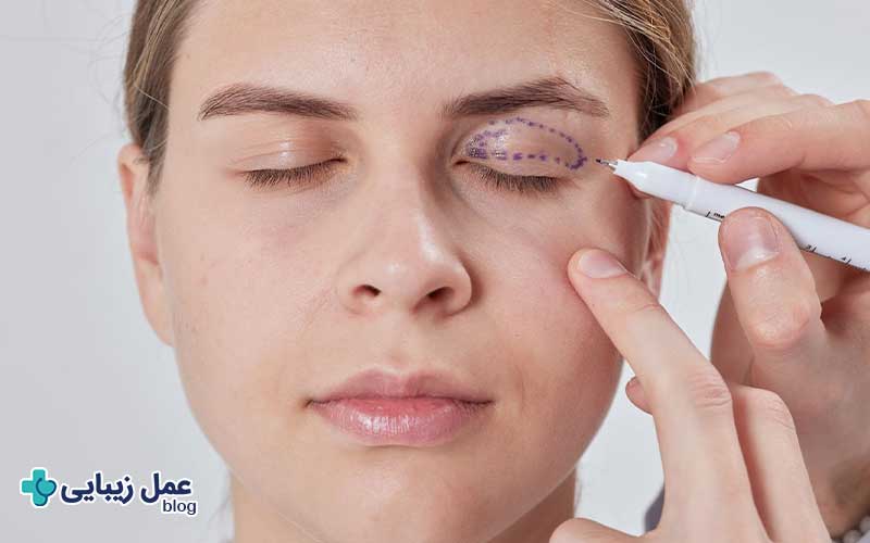 عمل بلفاروپلاستی 6 هزینه عمل بلفاروپلاستی چقدر است؟