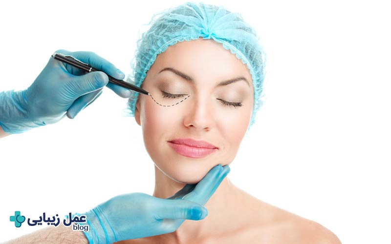 بلفاروپلاستی برای چه کسانی مناسب نیست؟ 2 آیا بلفاروپلاستی برای همه مناسب است؟
