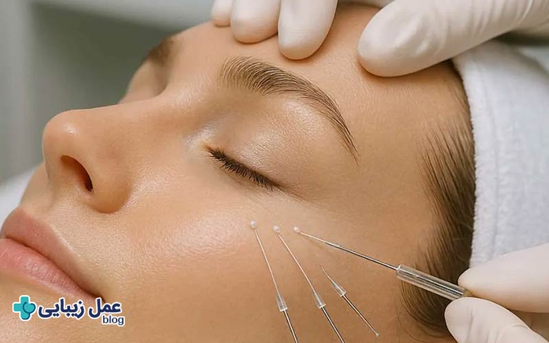 استفاده از نخ لیفت برای بالا کشیدن پلک