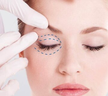 بلفاروپلاستی لیزری چیست و چگونه انجام می شود؟