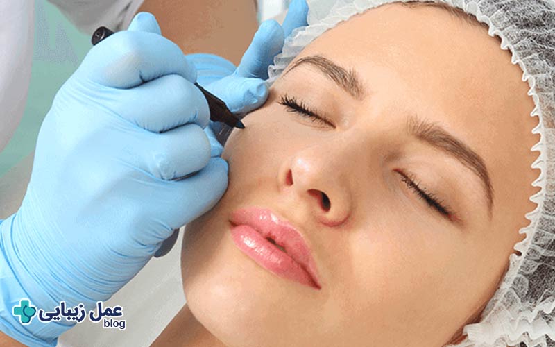 بلفاروپلاستی لیزری چیست؟