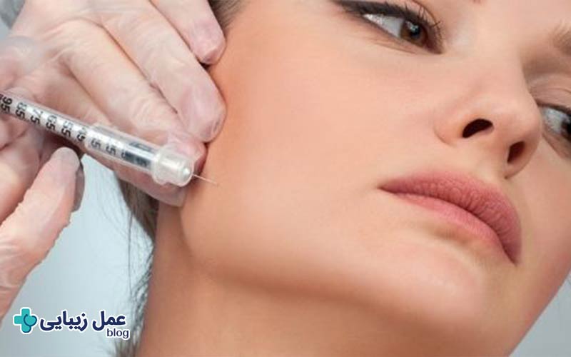 بهترین روش زاویه سازی فک؛ انواع، کاربردها و قیمت 3 زاویه سازی فک با تزریق بوتاکس