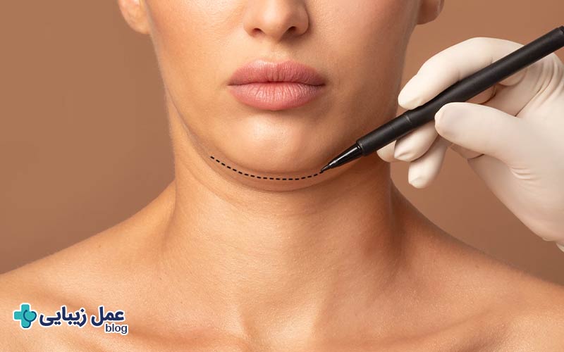 لیفت غبغب؛ مزایا، معایب و قیمت در سال 1404 5 عمل جراحی لیفت غبغب چگونه انجام می شود؟