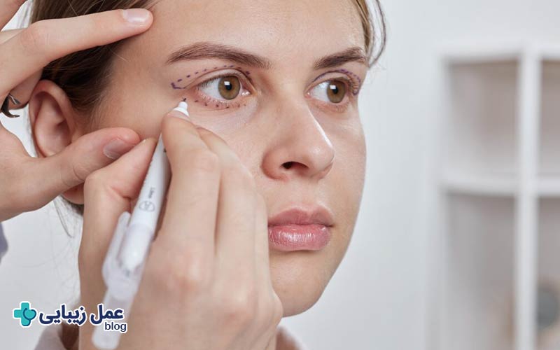 عمل زیبایی چشم چیست و چه تاثیری دارد؟ 4 عمل زیبایی چشم چگونه انجام می شود؟