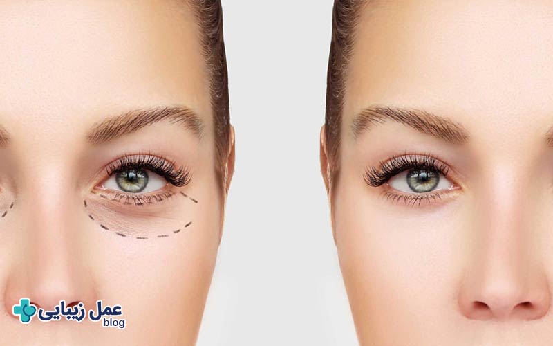 عمل زیبایی چشم چیست و چه تاثیری دارد؟ 2 عمل زیبایی چشم چیست؟