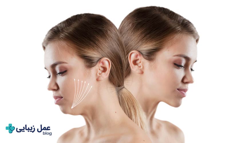 لیفت غبغب؛ مزایا، معایب و قیمت در سال 1404 2 لیفت غبغب چیست؟