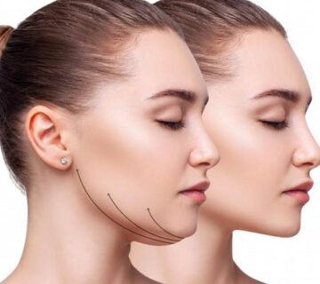 لیفت غبغب؛ مزایا، معایب و قیمت در سال 1404