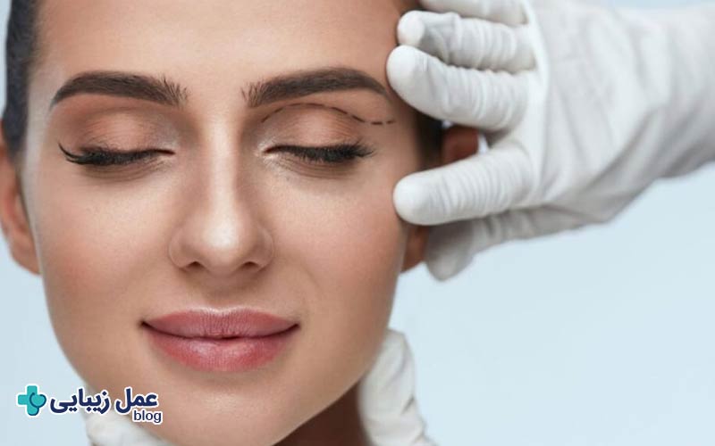 ماندگاری روش‌های غیر جراحی افتادگی پلک چقدر است؟