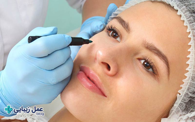 هزینه بلفاروپلاستی با لیزر چقدر است؟