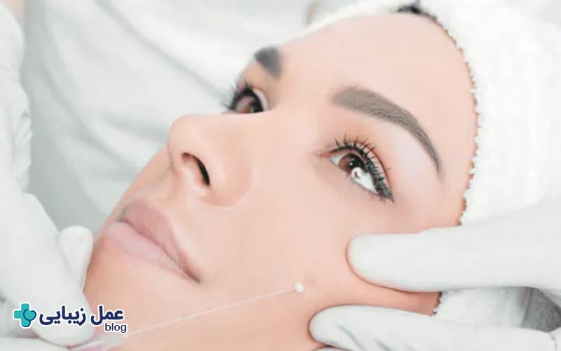 ماندگاری لیفت صورت با نخ چقدر است؟ 4 چرا لیفت با نخ توصیه نمی شود؟