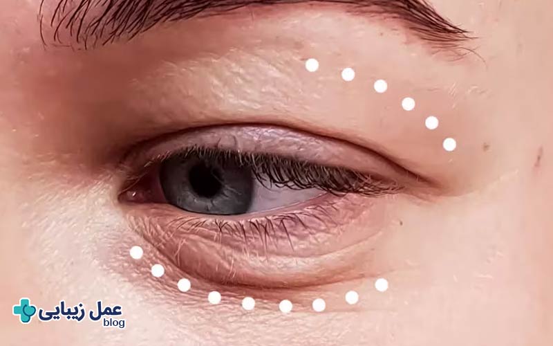 چگونه ماندگاری عمل پلک را بالا ببریم؟