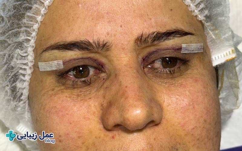 علت ورم بعد از بلفاروپلاستی