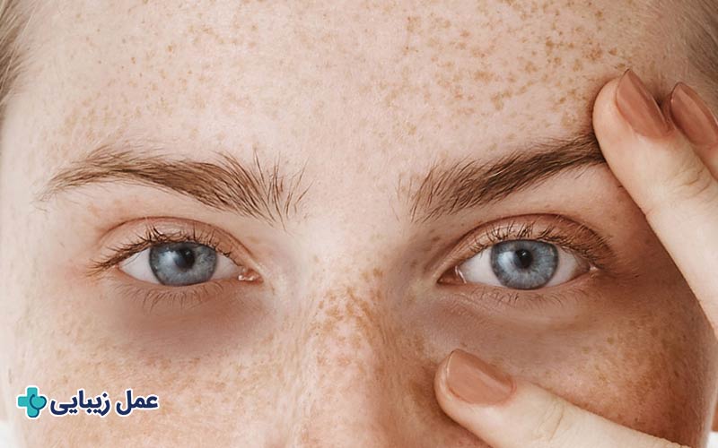 لیفت تحتانی ابرو چیست؟