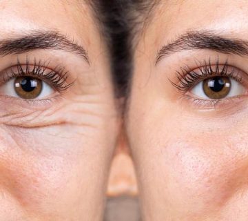 آیا بلفاروپلاستی برگشت‌ پذیر است؟