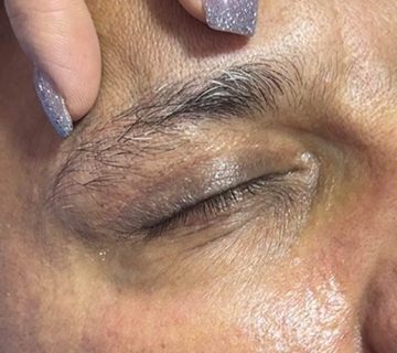 بخیه بلفاروپلاستی