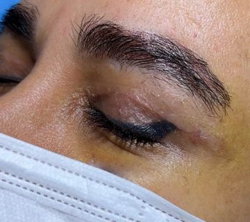 بهترین سن برای عمل بلفاروپلاستی