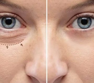 تفاوت بلفاروپلاستی پلک بالا و پایین