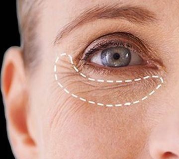 صفر تا صد خطرات بلفاروپلاستی در سنین بالا