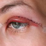 عوارض بلفاروپلاستی