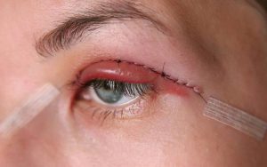 عوارض بلفاروپلاستی