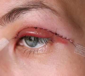 عوارض بلفاروپلاستی