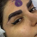 جای بخیه جراحی لیفت تحتانی ابرو