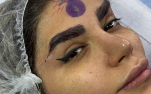 جای بخیه جراحی لیفت تحتانی ابرو