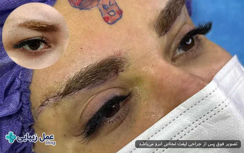 آمادگی‌های ضروری قبل از لیفت تحتانی ابرو