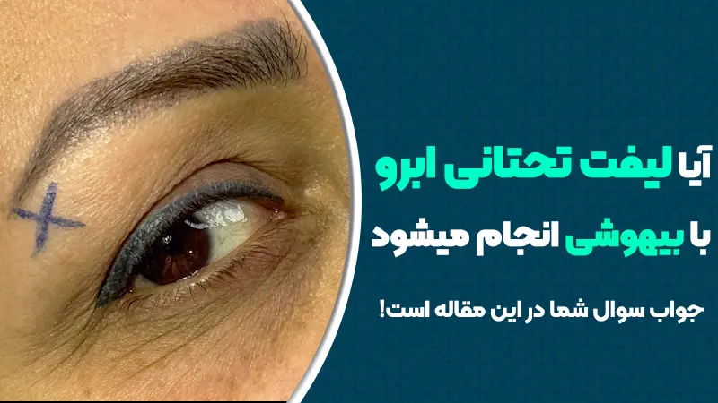 آیا لیفت تحتانی ابرو با بیهوشی انجام می‌شود؟