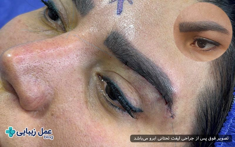 آیا لیفت تحتانی ابرو باعث ریزش ابرو می‌شود؟