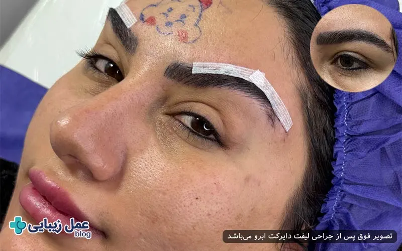 افتادگی ابرو و تاثیر آن بر روی چهره