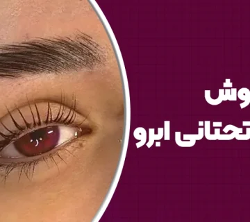 انواع روش لیفت تحتانی ابرو