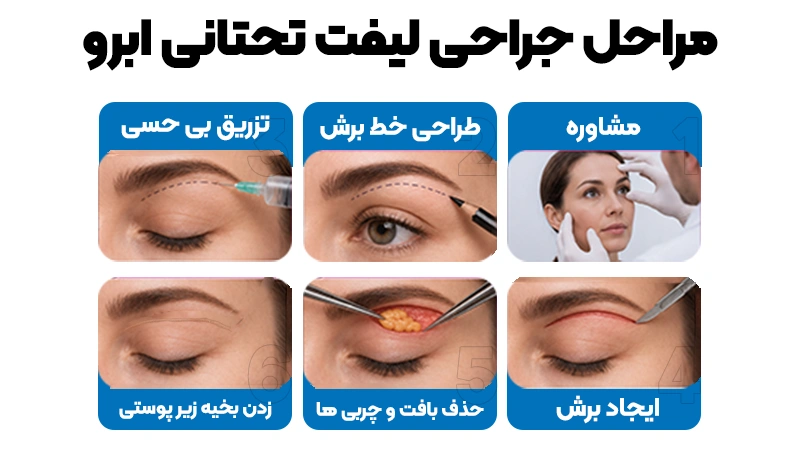 ۴) برش‌ها در لیفت تحتانی ابرو به چه صورت است؟