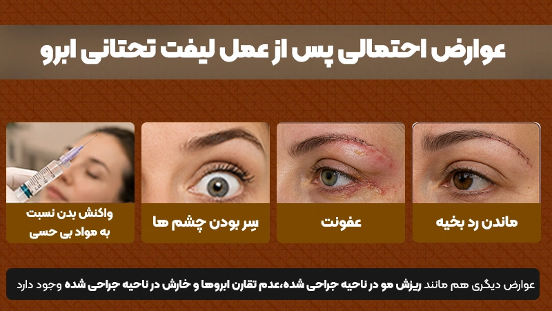 آیا سر شدن چشم‌ها بعد از لیفت تحتانی ابرو طبیعی است؟