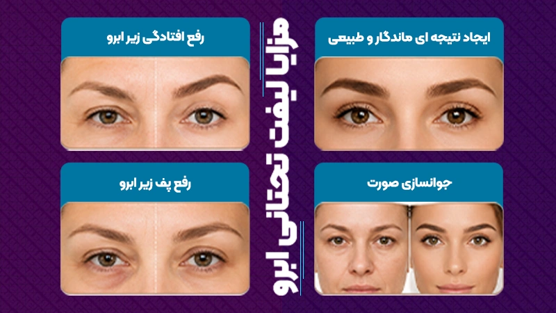 روش انجام لیفت تحتانی ابرو 2 بهترین روش جراحی زیبایی لیفت تحتانی ابرو