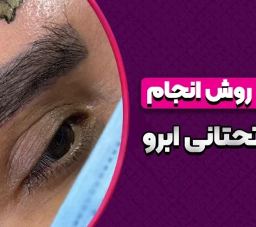 بهترین روش انجام لیفت تحتانی ابرو