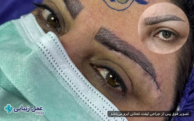 بهترین پزشک جراح در لیفت تحتانی ابرو
