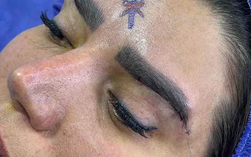 جراحی لیفت تحتانی ابرو چگونه انجام می‌شود؟