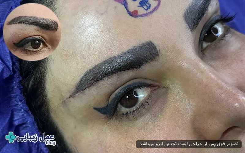 جراحی لیفت تحتانی، روشی برای رفع افتادگی ابرو