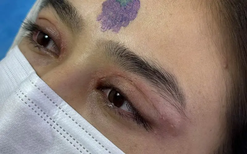دلایل افتادگی ابرو