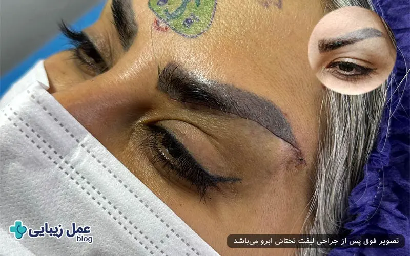 روش‌های رفع پف زیر ابرو
