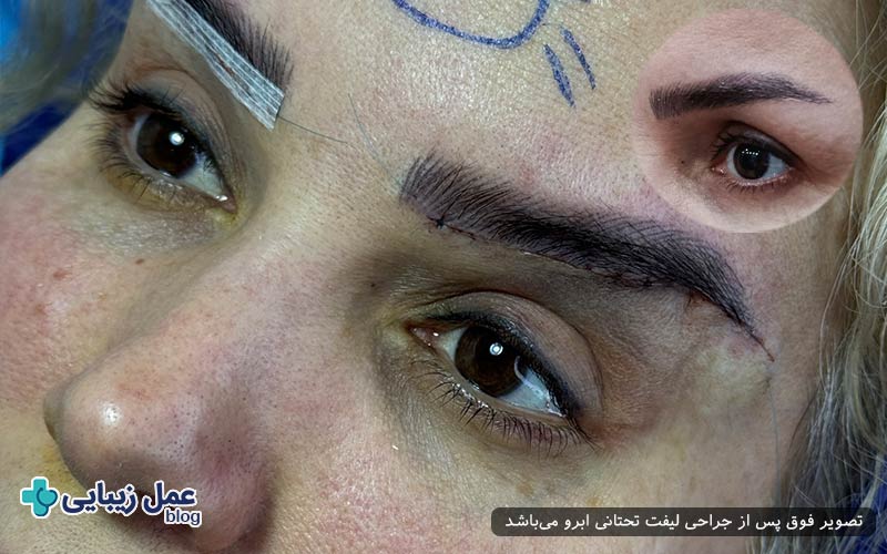 روش‌های کاهش درد در لیفت تحتانی ابرو